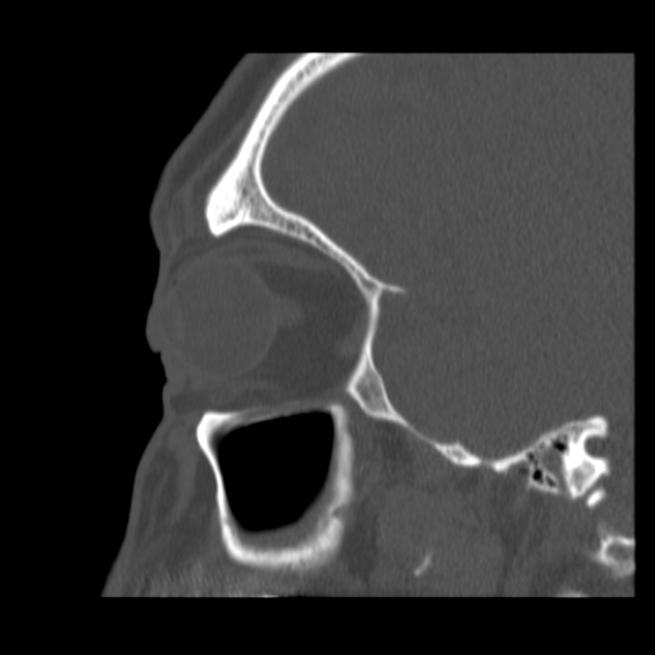 Acute sinusitis (Radiopaedia 23161-23215 Sagittal bone window 48).jpg
