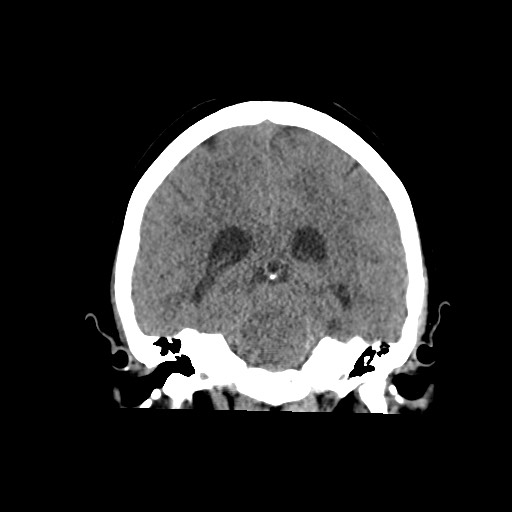 Acute subarachnoid hemorrhage and accessory anterior cerebral artery (Radiopaedia 69231-79008 Coronal non-contrast 44).jpg