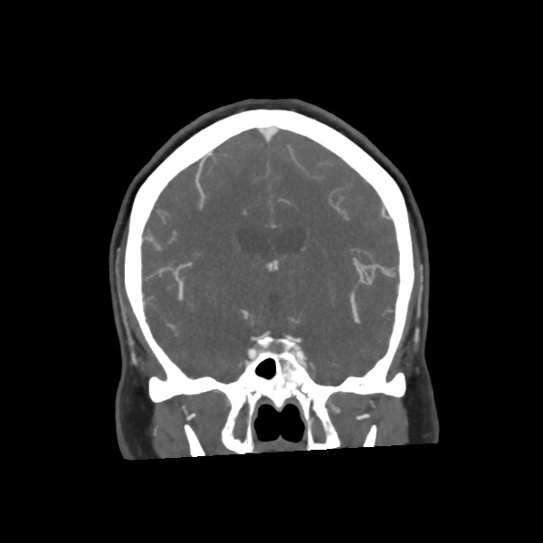 Acute subarachnoid hemorrhage and accessory anterior cerebral artery (Radiopaedia 69231-79009 Coronal C+ arterial phase 40).jpg