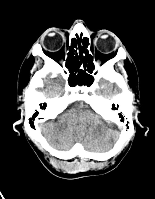 Acute superior cerebellar artery territory infarct (Radiopaedia 84104-99359 Axial non-contrast 53).jpg