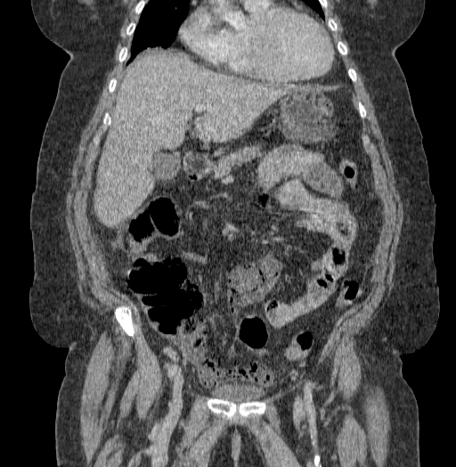 Acute superior mesenteric artery occlusion (Radiopaedia 51288-56960 Coronal C+ portal venous phase 31).jpg