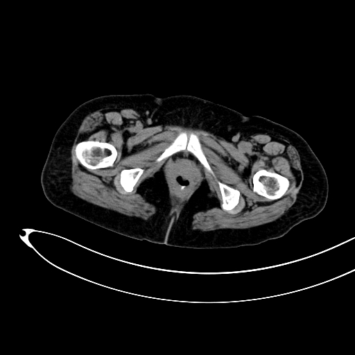 Adenocarcinoma colon with intussusception (Radiopaedia 86006-101922 Axial non-contrast 67).jpg