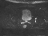Adenocarcioma of rectum- T1 lesion (Radiopaedia 36921-38546 Axial DWI 43).png