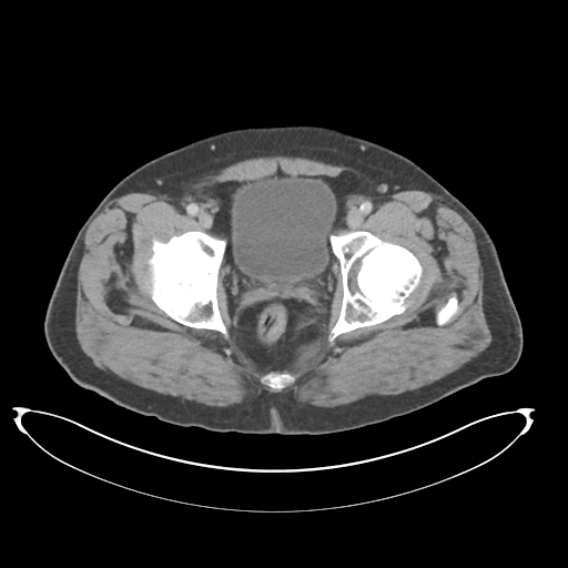 Adenocarcioma of rectum- T1 lesion (Radiopaedia 36921-38547 Axial C+ portal venous phase 83).png