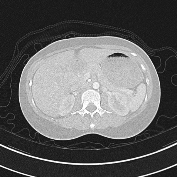 File:Adenocystic carcinoma of the trachea (Radiopaedia 47677-52525 Axial lung window 84).jpg