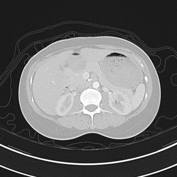 Adenocystic carcinoma of the trachea (Radiopaedia 47677-52525 Axial lung window 85).jpg