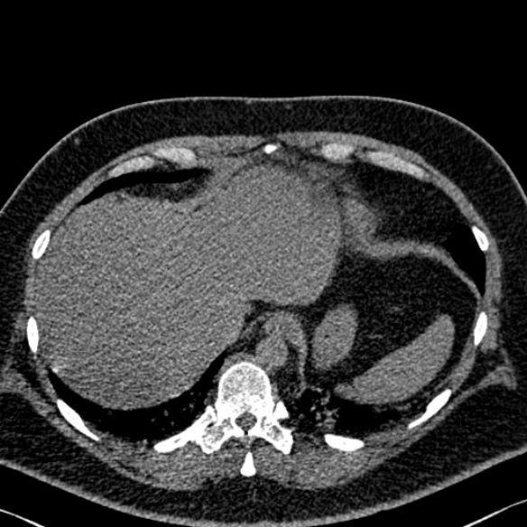 Adenoid cystic carcinoma of the trachea (Radiopaedia 49042-54137 Axial non-contrast 292).jpg
