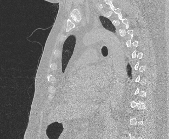 Adenoid cystic carcinoma of the trachea (Radiopaedia 49042-54137 Sagittal lung window 267).jpg