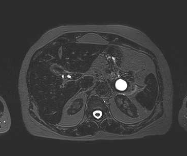 File:Adenomyomatosis of the gallbladder (Radiopaedia 50246-55587 Axial 74).png