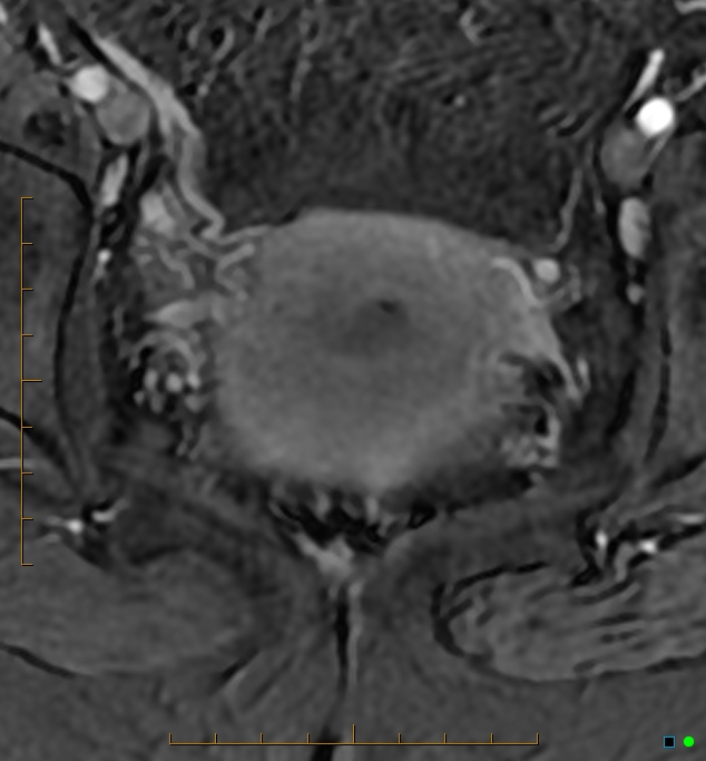 Adenomyosis uterus with hematometra (Radiopaedia 45779-50011 Axial T1 C+ fat sat 44).jpg