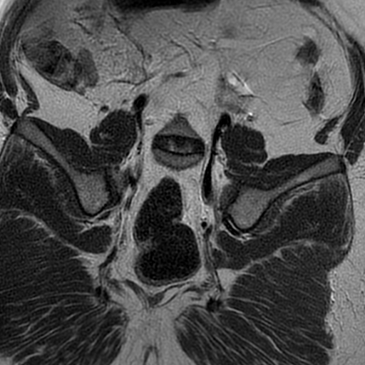 File:Adenomyosis within a didelphys uterus (Radiopaedia 70175-80215 Coronal T2 29).jpg