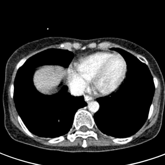 Adhesional small bowel obstruction (Radiopaedia 48397-53305 Axial C+ portal venous phase 1).jpg