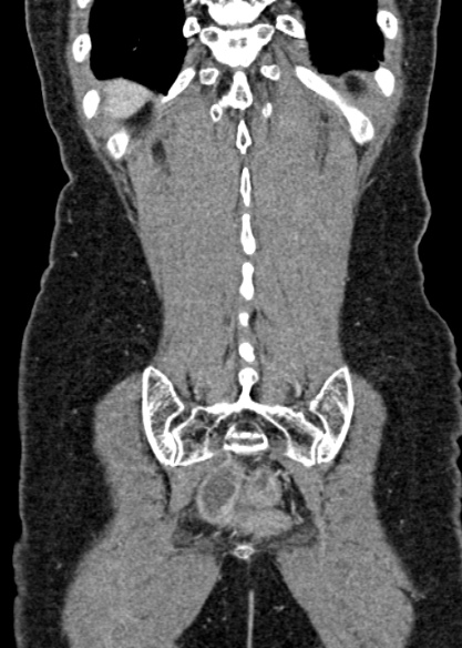 Adhesional small bowel obstruction (Radiopaedia 48397-53305 Coronal C+ portal venous phase 302).jpg