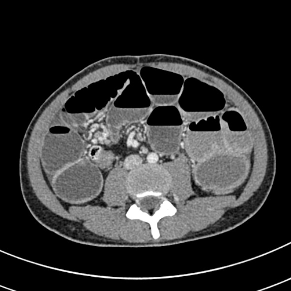 File:Adhesional small bowel obstruction (Radiopaedia 52107-57980 Axial C+ portal venous phase 68).jpg