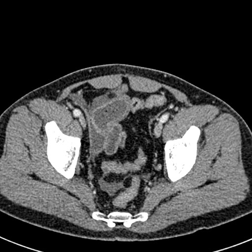 Adhesional small bowel obstruction (Radiopaedia 58900-66131 Axial C+ portal venous phase 47).jpg