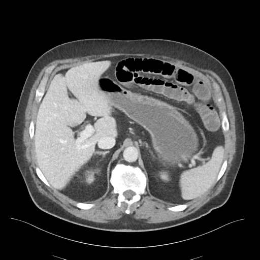 Adhesions within abdominal wall hernia (Radiopaedia 58283-65394 Axial C+ portal venous phase 23).png