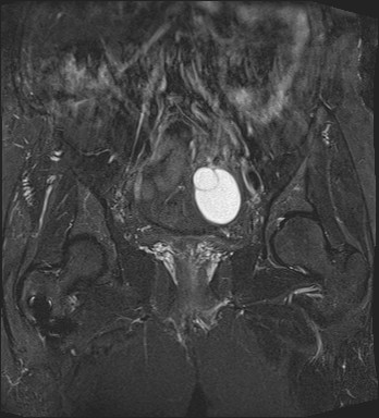 File:Adnexal multilocular cyst (O-RADS US 3- O-RADS MRI 3) (Radiopaedia 87426-103754 Coronal T2 fat sat 17).jpg