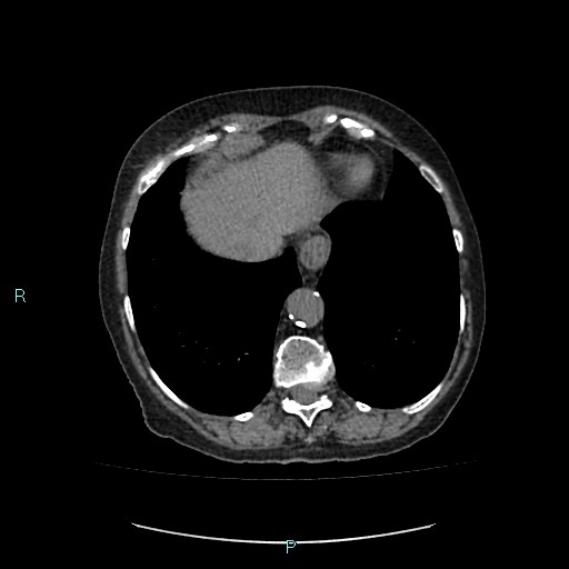 File:Adrenal collision tumor (ACT) (Radiopaedia 48462-53379 Axial non-contrast 6).jpg