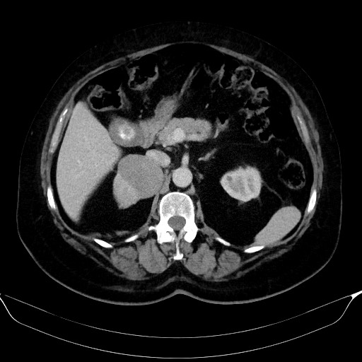 Adrenal cortical carcinoma (Radiopaedia 64017-72769 Axial C+ portal venous phase 23).jpg