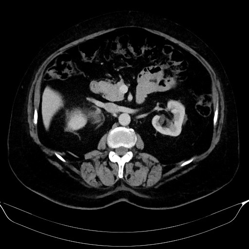 Adrenal cortical carcinoma (Radiopaedia 64017-72769 Axial C+ portal venous phase 27).jpg