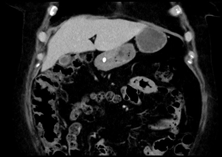 File:Adrenal cortical carcinoma (Radiopaedia 64017-72769 Coronal C+ portal venous phase 14).jpg