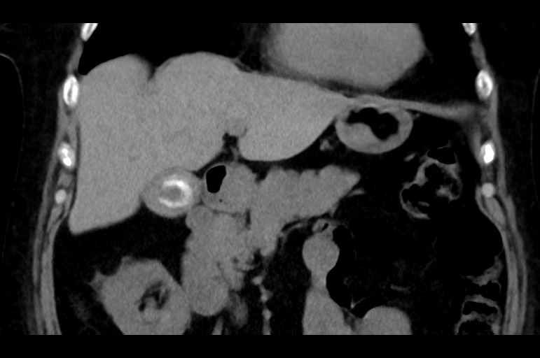Adrenal cortical carcinoma (Radiopaedia 64017-72769 Coronal non-contrast 21).jpg