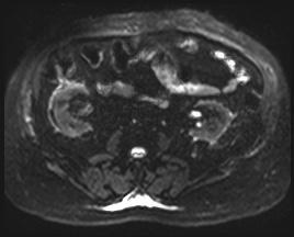 Adrenal cortical carcinoma (Radiopaedia 64017-72770 Axial DWI 30).jpg