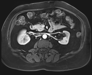 Adrenal cortical carcinoma (Radiopaedia 64017-72770 I 45).jpg