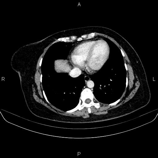 File:Adrenal cortical carcinoma (Radiopaedia 84882-100379 Axial C+ portal venous phase 5).jpg