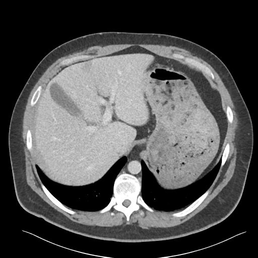 File:Adrenal cyst (Radiopaedia 45625-49777 Axial C+ portal venous phase 24).png