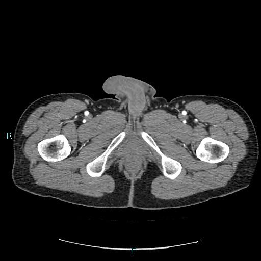Adrenal cystic lymphangioma (Radiopaedia 83161-97534 Axial C+ arterial phase 108).jpg