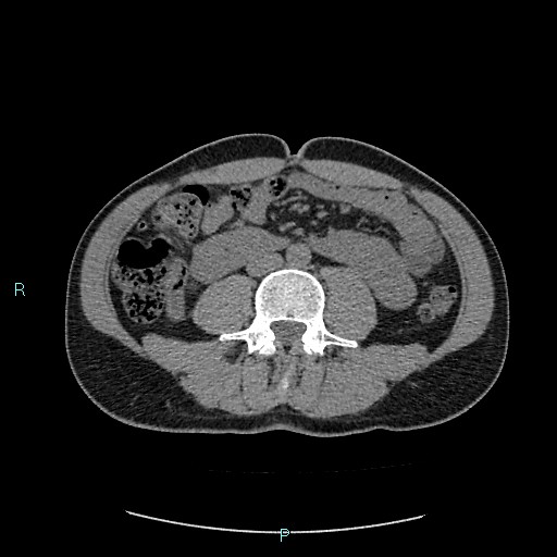 Adrenal cystic lymphangioma (Radiopaedia 83161-97534 Axial non-contrast 54).jpg