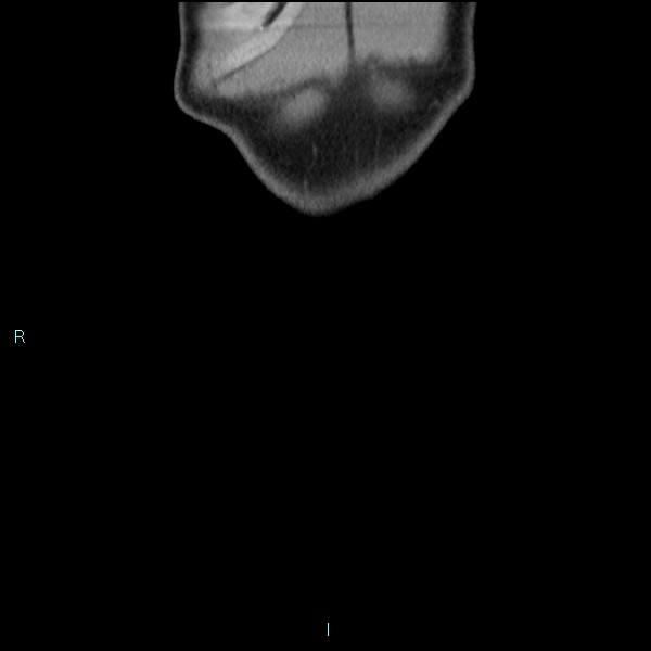 Adrenal cystic lymphangioma (Radiopaedia 83161-97534 Coronal C+ portal venous phase 4).jpg