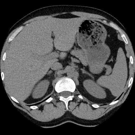 Adrenal gland trauma (Radiopaedia 81351-95079 Axial non-contrast 30).jpg