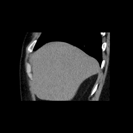 Adrenal gland trauma (Radiopaedia 81351-95079 Sagittal non-contrast 16).jpg