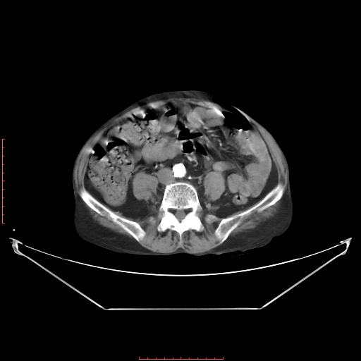Adrenal hemangioma (Radiopaedia 68923-78668 Axial C+ arterial phase 48).jpg
