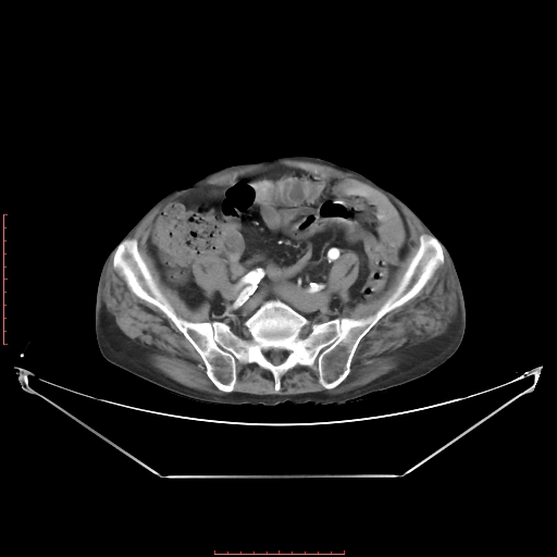 Adrenal hemangioma (Radiopaedia 68923-78668 Axial C+ arterial phase 55).jpg