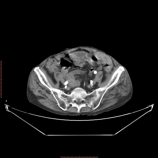 Adrenal hemangioma (Radiopaedia 68923-78668 Axial C+ arterial phase 57).jpg