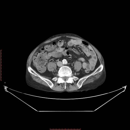 Adrenal hemangioma (Radiopaedia 68923-78668 Axial C+ portal venous phase 47).jpg