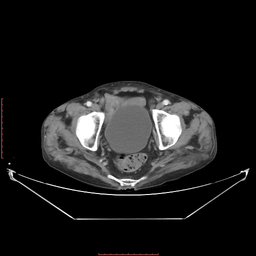 Adrenal hemangioma (Radiopaedia 68923-78668 Axial C+ portal venous phase 64).jpg