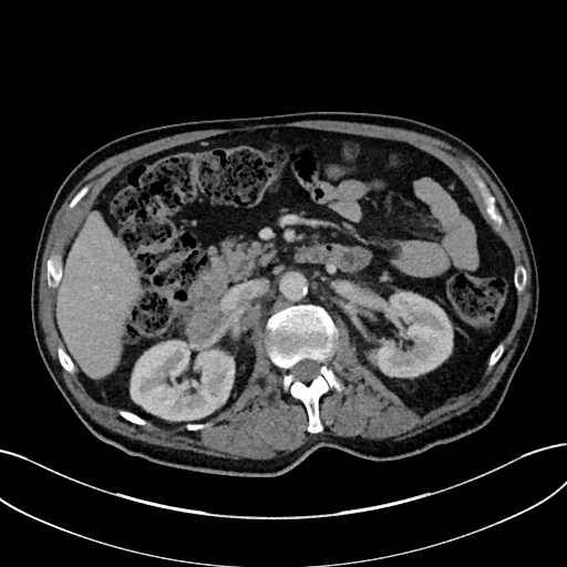 Adrenal lymphoma (Radiopaedia 73730-84529 Axial C+ portal venous phase 45).jpg