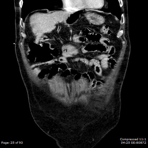 Adrenal metastasis (Radiopaedia 78425-91079 Sagittal C+ portal venous phase 12).jpg