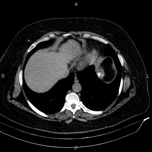 Adrenal myelolipoma (Radiopaedia 84319-99617 Axial With oral contrast 25).jpg