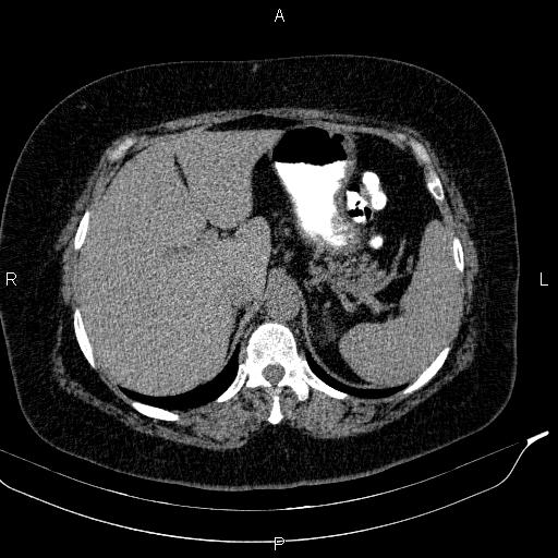 Adrenal myelolipoma (Radiopaedia 84319-99617 Axial With oral contrast 53).jpg