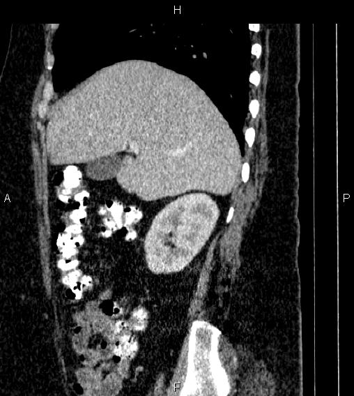 Adrenal myelolipoma (Radiopaedia 84319-99617 Sagittal renal cortical phase 25).jpg
