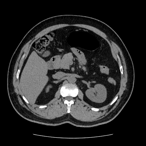 Adrenal myelolipoma and beaver tail liver (Radiopaedia 86201-102193 Axial non-contrast 171).jpg