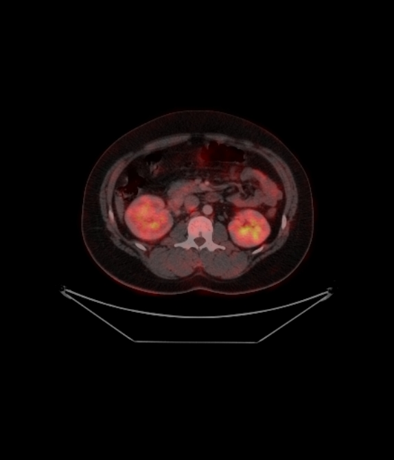 Adrenocortical carcinoma (Radiopaedia 80134-93440 ِAxial 180).jpg