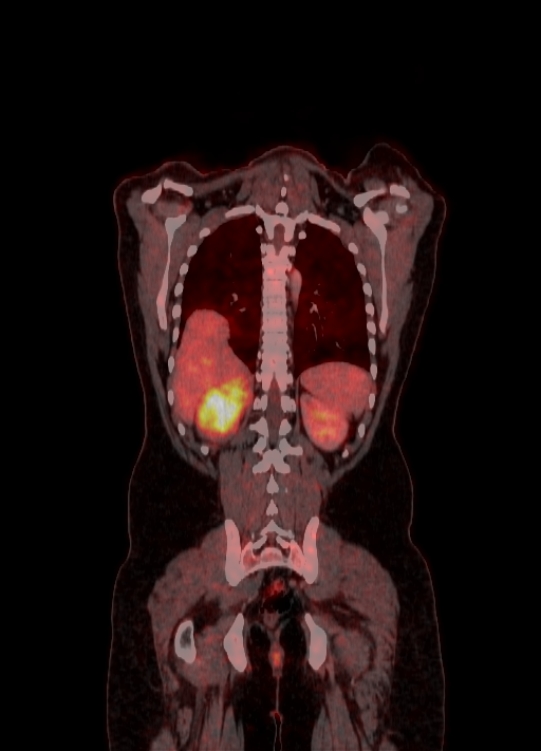 Adrenocortical carcinoma (Radiopaedia 80134-93440 Coronal 146).jpg