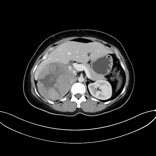 Adrenocortical carcinoma (Radiopaedia 87281-103569 Axial C+ portal venous phase 31).jpg