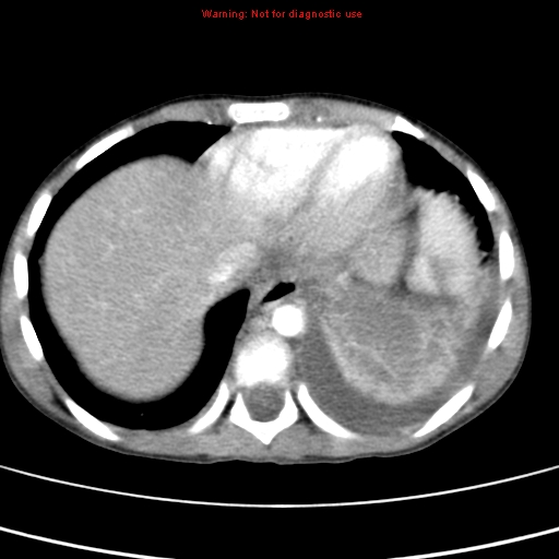File:Adrenocortical carcinoma (Radiopaedia 9449-10131 Axial C+ portal venous phase 5).jpg